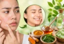 चेहरे की फुंसियां कैसे ठीक करें? जानिए असरदार घरेलू नुस्खे और बचाव के आसान तरीके