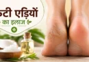फटी एड़ियों का इलाज: घरेलू उपाय, कारण, बचाव और मुलायम एड़ियां पाने के आसान तरीके (2026)