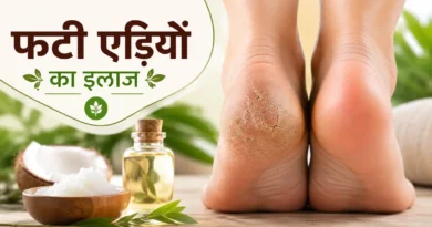 फटी एड़ियों का इलाज: घरेलू उपाय, कारण, बचाव और मुलायम एड़ियां पाने के आसान तरीके (2026)