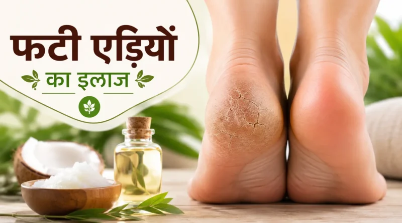 फटी एड़ियों का इलाज: घरेलू उपाय, कारण, बचाव और मुलायम एड़ियां पाने के आसान तरीके (2026)