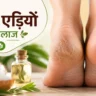 फटी एड़ियों का इलाज: घरेलू उपाय, कारण, बचाव और मुलायम एड़ियां पाने के आसान तरीके (2026)