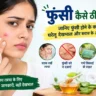 फुंसी कैसे ठीक करें, फुंसी कैसे सही करें, चेहरे की फुंसी कैसे हटाएं, फुंसी का घरेलू उपाय, फुंसी का इलाज, चेहरे पर फुंसी क्यों होती है, फुंसी जल्दी कैसे ठीक करें, दर्द वाली फुंसी कैसे ठीक करें, फुंसी में क्या लगाएं, फुंसी होने के कारण, चेहरे के दाने कैसे ठीक करें, मुंहासे कैसे ठीक करें, पिंपल कैसे हटाएं, pimple kaise thik kare, funsi kaise thik kare, pimple treatment in hindi